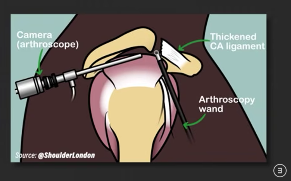 어깨 충돌증후군
감압수술