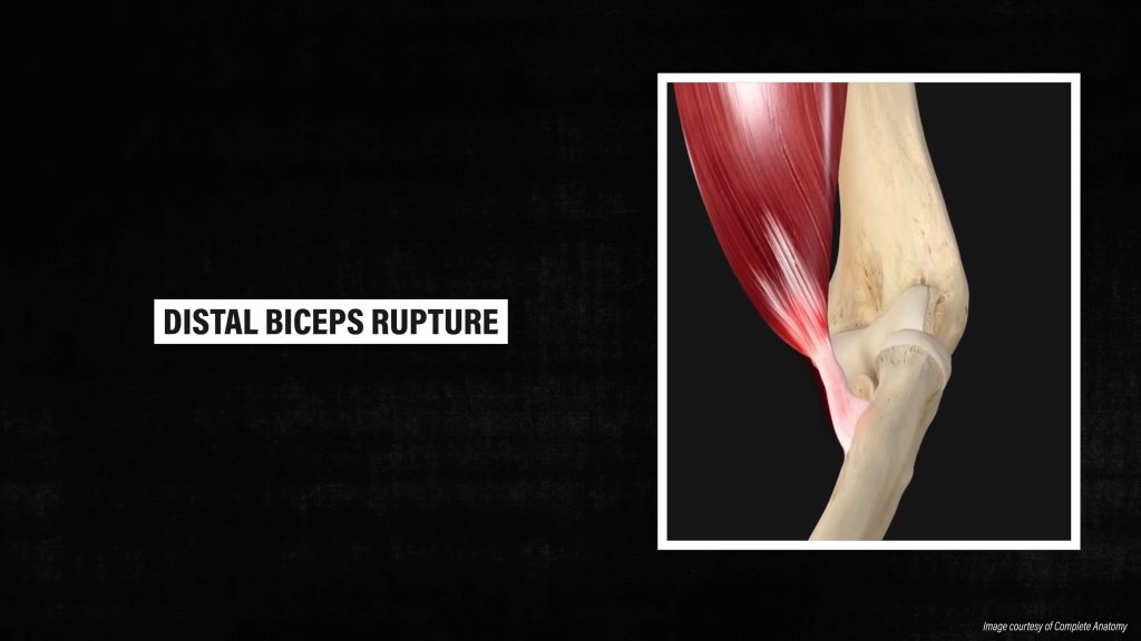 distal biceps rupture